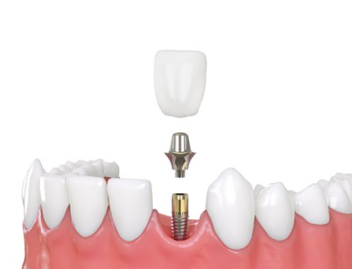 What to Expect When Getting a Dental Implant
