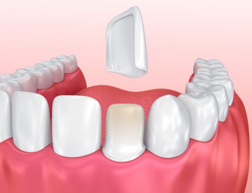 Quickly Fix a Chipped Tooth With Veneers