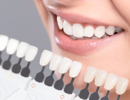 What Are Porcelain Veneers?