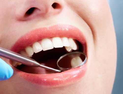 The Benefits of Switching to White Fillings