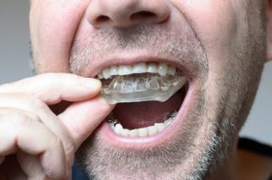 man placing mouth guard