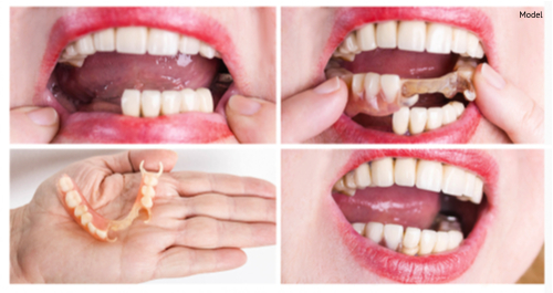 dental rehabilitation with lower flexible nylon denture, before and after treatment-img-blog