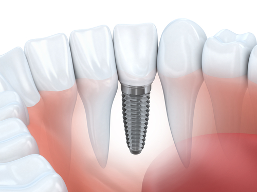 tooth human implant done in 3d graphics-img-blog